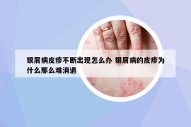 銀屑病皮疹不斷出現(xiàn)怎么辦 銀屑病的皮疹為什么那么難消退