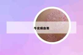 牛皮癬血寒