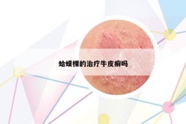 蛤蟆棵的治療牛皮癬嗎