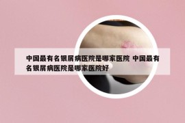 中國(guó)最有名銀屑病醫(yī)院是哪家醫(yī)院 中國(guó)最有名銀屑病醫(yī)院是哪家醫(yī)院好