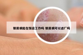 銀屑病能在飯店工作嗎 銀屑病可以進(jìn)廠嗎