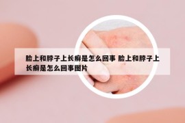 臉上和脖子上長(zhǎng)癬是怎么回事 臉上和脖子上長(zhǎng)癬是怎么回事圖片