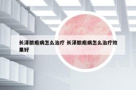 長澤膿皰病怎么治療 長澤膿皰病怎么治療效果好