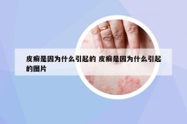 皮癬是因?yàn)槭裁匆鸬?皮癬是因?yàn)槭裁匆鸬膱D片