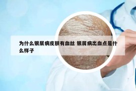 為什么銀屑病皮膚有血絲 銀屑病出血點(diǎn)是什么樣子