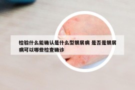 檢驗(yàn)什么能確認(rèn)是什么型銀屑病 是否是銀屑病可以哪些檢查確診