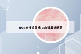 UUB治療銀屑病 ucb銀屑病新藥