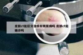 皮膚ct能區(qū)分濕疹和銀屑病嗎 皮膚ct能確診嗎