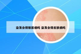 染發(fā)會(huì)得銀屑病嗎 染發(fā)會(huì)得皮膚病嗎
