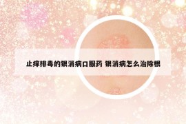 止癢排毒的銀消病口服藥 銀消病怎么治除根