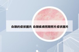 白顛的癥狀圖片 白顛瘋病初期照片癥狀圖片