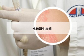 小孩跟牛皮癬