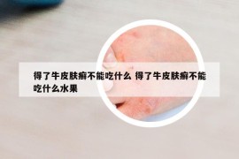 得了牛皮膚癬不能吃什么 得了牛皮膚癬不能吃什么水果