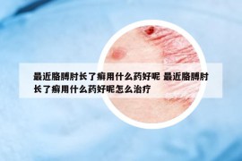 最近胳膊肘長了癬用什么藥好呢 最近胳膊肘長了癬用什么藥好呢怎么治療