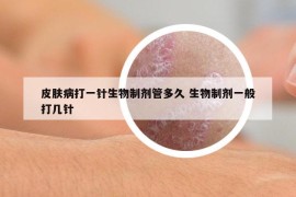 皮膚病打一針生物制劑管多久 生物制劑一般打幾針