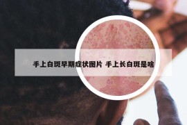 手上白斑早期癥狀圖片 手上長(zhǎng)白斑是啥