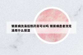 銀屑病洗澡后擦藥膏可以嗎 銀屑病患者洗完澡用什么保濕