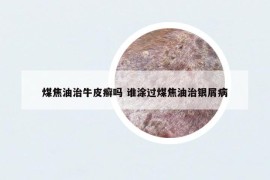 煤焦油治牛皮癬嗎 誰涂過煤焦油治銀屑病