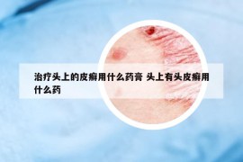 治療頭上的皮癬用什么藥膏 頭上有頭皮癬用什么藥