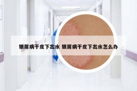 銀屑病干皮下出水 銀屑病干皮下出水怎么辦