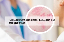卡泊三醇能治頭部銀屑病嗎 卡泊三醇藥膏治療銀屑病怎么樣
