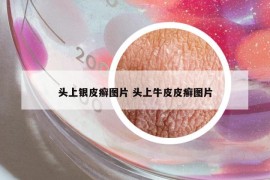 頭上銀皮癬圖片 頭上牛皮皮癬圖片