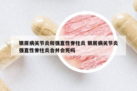 銀屑病關(guān)節(jié)炎和強(qiáng)直性脊柱炎 銀屑病關(guān)節(jié)炎強(qiáng)直性脊柱炎合并會(huì)死嗎