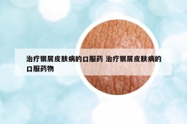 治療銀屑皮膚病的口服藥 治療銀屑皮膚病的口服藥物