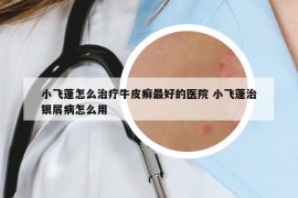 小飛蓬怎么治療牛皮癬最好的醫(yī)院 小飛蓬治銀屑病怎么用