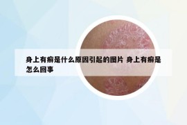 身上有癬是什么原因引起的圖片 身上有癬是怎么回事