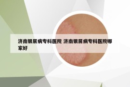 濟南銀屑病?？漆t(yī)院 濟南銀屑病?？漆t(yī)院哪家好