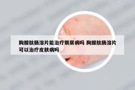 胸腺肽腸溶片能治療銀屑病嗎 胸腺肽腸溶片可以治療皮膚病嗎