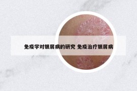 免疫學對銀屑病的研究 免疫治療銀屑病