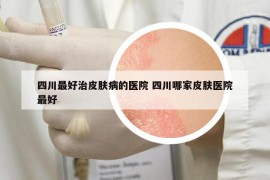 四川最好治皮膚病的醫(yī)院 四川哪家皮膚醫(yī)院最好