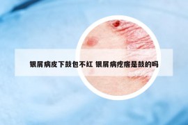 銀屑病皮下鼓包不紅 銀屑病疙瘩是鼓的嗎