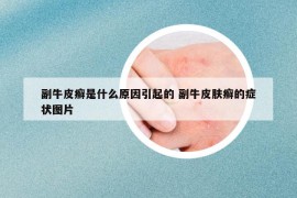 副牛皮癬是什么原因引起的 副牛皮膚癬的癥狀圖片