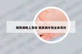 銀屑病晚上發(fā)燒 銀屑病半夜全身發(fā)熱