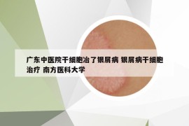 廣東中醫(yī)院干細(xì)胞冶了銀屑病 銀屑病干細(xì)胞治療 南方醫(yī)科大學(xué)