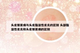 頭皮銀屑病與頭皮脂溢性皮炎的區(qū)別 頭部脂溢性皮炎和頭皮銀屑病的區(qū)別