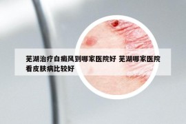 蕪湖治療白癜風(fēng)到哪家醫(yī)院好 蕪湖哪家醫(yī)院看皮膚病比較好