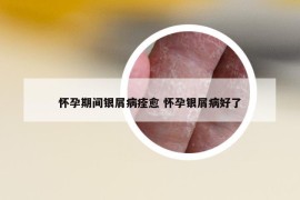 懷孕期間銀屑病痊愈 懷孕銀屑病好了