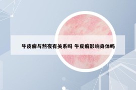 牛皮癬與熬夜有關(guān)系嗎 牛皮癬影響身體嗎