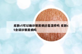 皮膚ct可以確診銀屑病還是濕疹嗎 皮膚ct會誤診銀屑病嗎