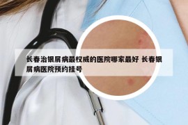 長春治銀屑病最權(quán)威的醫(yī)院哪家最好 長春銀屑病醫(yī)院預(yù)約掛號