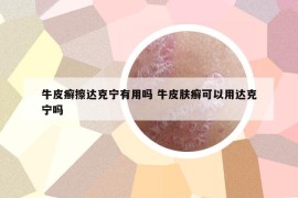 牛皮癬擦達克寧有用嗎 牛皮膚癬可以用達克寧嗎