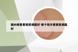 國(guó)內(nèi)哪里看銀屑病最好 哪個(gè)地方看銀屑病最好