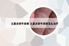 兒童點(diǎn)狀牛皮癬 兒童點(diǎn)狀牛皮癬怎么治療