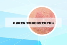 銀屑病查尿 銀屑病化驗(yàn)檢查哪些指標(biāo)
