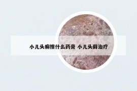 小兒頭癬擦什么藥膏 小兒頭蘚治療