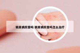 銀屑病厲害嗎 銀屑病厲害嗎怎么治療